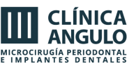 implantes-dentales-clinica-angulo-por-apeña